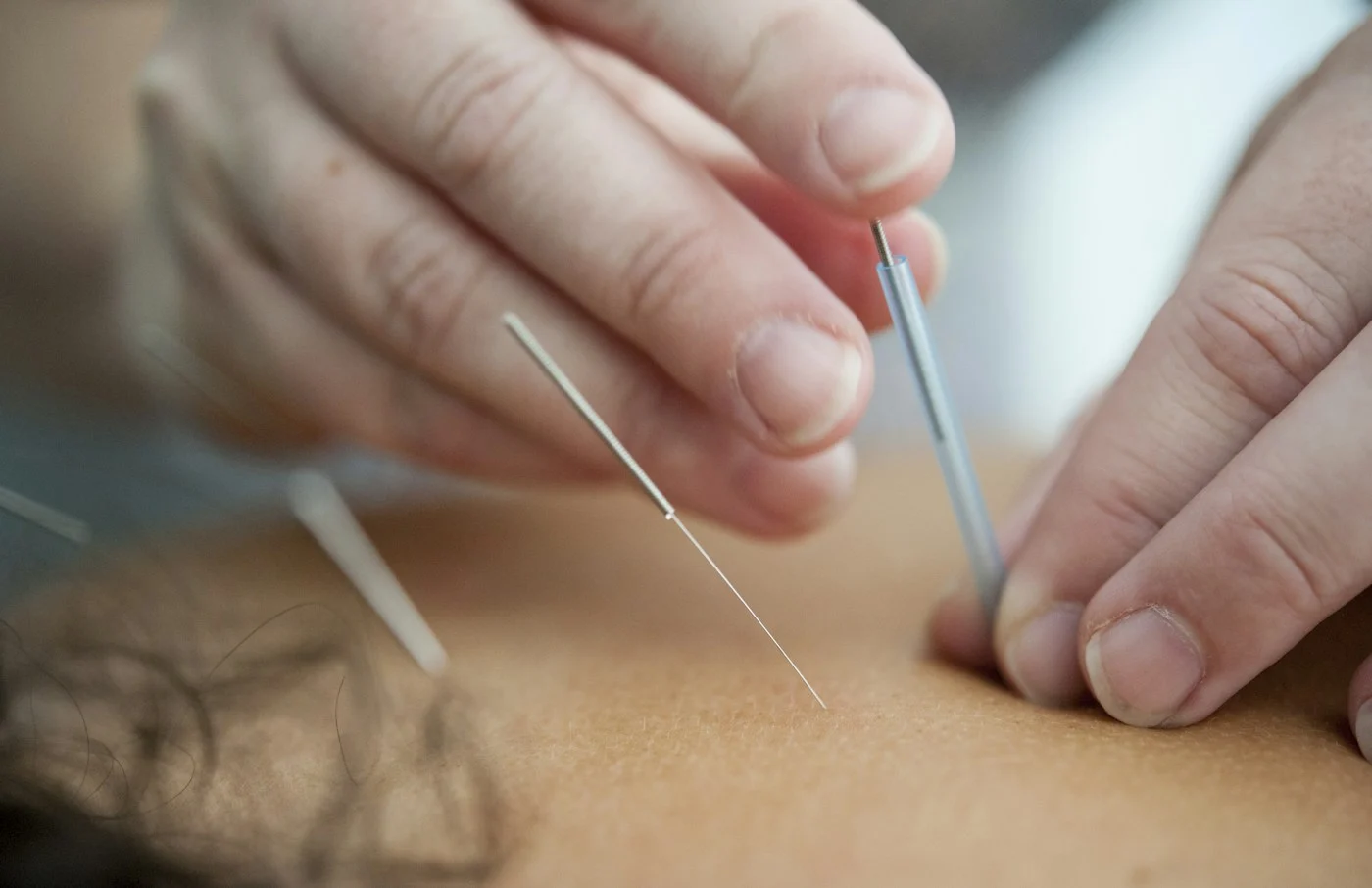 A practitioner placing an acupuncture needle in a patient’s shoulder